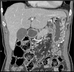 Pancreatic Cancer - CTisus CT Scan