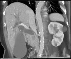 Obstructed Common Bile Duct (CBD) By Ampullary Mass - CTisus CT Scan