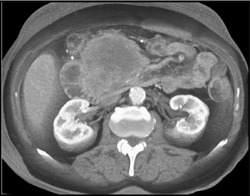 Islet Cell Tumor - CTisus CT Scan