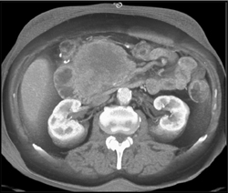 Islet Cell Tumor - CTisus CT Scan