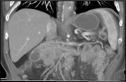 Islet Cell Tumor - CTisus CT Scan