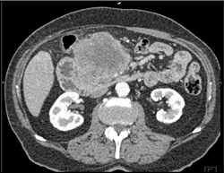 Islet Cell Tumor - CTisus CT Scan