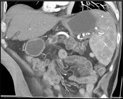 Multiple Intraductal Papillary Mucinous Neoplasms (IPMNs) - CTisus CT Scan