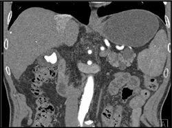 Multiple Intraductal Papillary Mucinous Neoplasms (IPMNs) - CTisus CT Scan