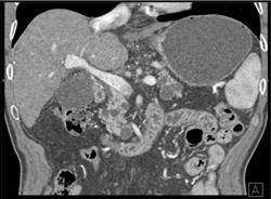 Multiple Intraductal Papillary Mucinous Neoplasms (IPMNs) - CTisus CT Scan