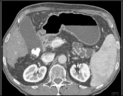 Multiple Intraductal Papillary Mucinous Neoplasms (IPMNs) - CTisus CT Scan