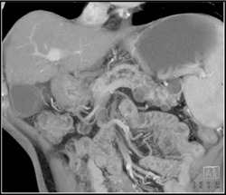 Multiple Intraductal Papillary Mucinous Neoplasms (IPMNs) - CTisus CT Scan