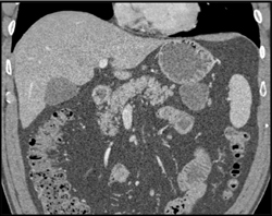 Multiple Intraductal Papillary Mucinous Neoplasms (IPMNs) - CTisus CT Scan