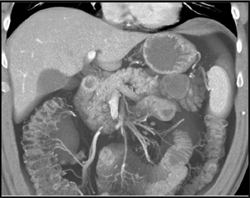 Multiple Intraductal Papillary Mucinous Neoplasms (IPMNs) - CTisus CT Scan