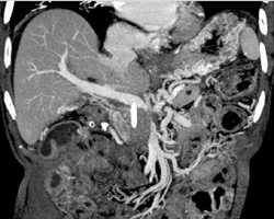 Pancreatic Cancer Encases the PV/SMV Junction - CTisus CT Scan