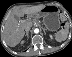 Pancreatic Cancer Encases the Splenic Vein and the Celiac Axis - CTisus CT Scan