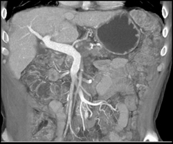 Pancreatic Cancer Encases the SMA and the Splenic Vein - CTisus CT Scan