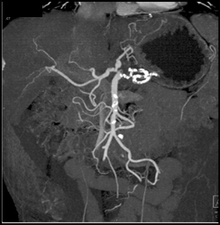 Atherosclerotic Disease SMA and Celiac Artery - CTisus CT Scan