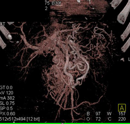 Pancreatic Cancer Encases the PV With Cavernous Transformation of the Portal Vein (CTPV) - CTisus CT Scan