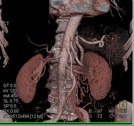 Superior Mesenteric Artery (SMA) Stenosis - CTisus CT Scan