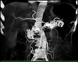 Chronic Pancreatitis - CTisus CT Scan