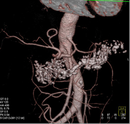 Chronic Pancreatitis - CTisus CT Scan