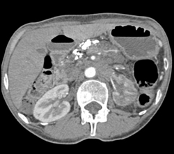 Pancreatic Cancer in A Patient With Chronic Pancreatitis - CTisus CT Scan