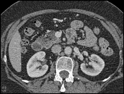 Carcinoma in A Cystic Lesion - CTisus CT Scan