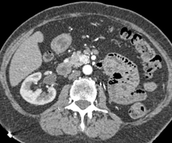 Insulinoma - CTisus CT Scan