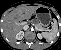 Solid and Papillary Epithelial Neoplasm - CTisus CT Scan