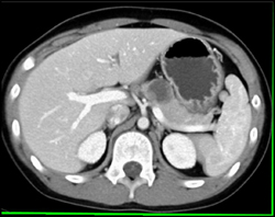 Solid and Cystic Papillary Epithelial Neoplasm- SPEN - CTisus CT Scan