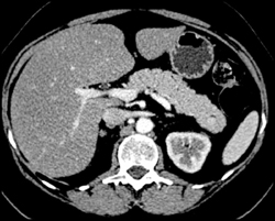 1 Cm Islet Cell in Tail of Pancreas - CTisus CT Scan