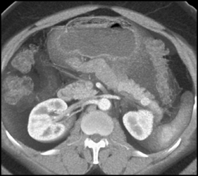 Insulinoma - CTisus CT Scan