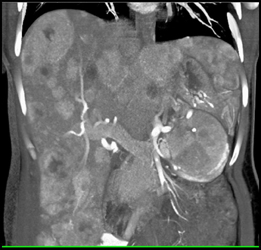 Neuroendocrine Tumor With Liver Metastases - CTisus CT Scan