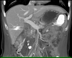 Chronic Pancreatitis - CTisus CT Scan