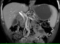 Pancreatic Cancer Encases the PV/SMV Confluence - CTisus CT Scan