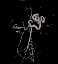 Collaterals Off Mesenteric Artery - CTisus CT Scan