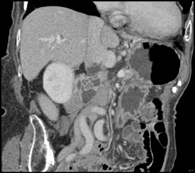 Intraductal Papillary Mucinous Neoplasm (IPMN) - CTisus CT Scan