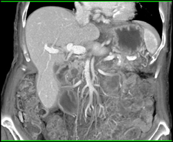 Intraductal Papillary Mucinous Neoplasm (IPMN) - CTisus CT Scan