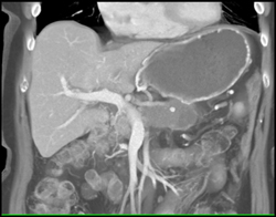 Adenocarcinoma Encases Splenic Vein and Artery - CTisus CT Scan