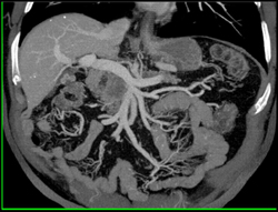 Pancreatic Cancer Invades PV-SMV- subtle - CTisus CT Scan