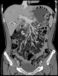 Chronic Pancreatitis - CTisus CT Scan