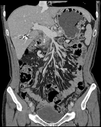 Chronic Pancreatitis - CTisus CT Scan