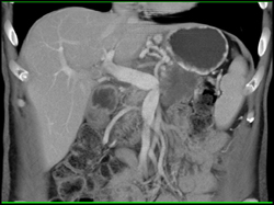 Pancreatic Cancer Occludes Splenic Vein and Invades Left Renal Artery. See Flow Changes in Left Kidney - CTisus CT Scan