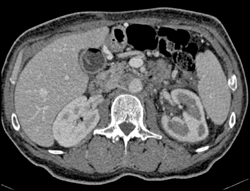 Pancreatic Cancer Encases the Left Renal Artery-see Changes in Left Renal Enhancement - CTisus CT Scan