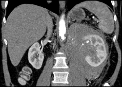 Lymphoma Infiltrates Kidney and Pancreas - CTisus CT Scan