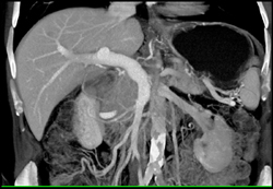 Pancreatic Cancer - CTisus CT Scan