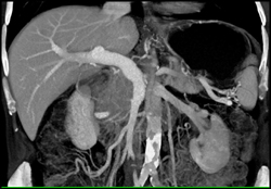 Pancreatic Cancer - CTisus CT Scan