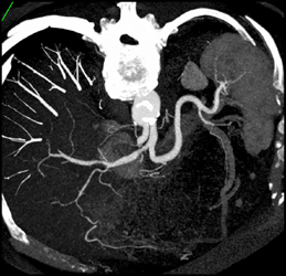 Encased Hepatic Artery Near Origin - CTisus CT Scan