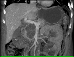 Cystadenoma - CTisus CT Scan