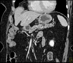 Intraductal Papillary Mucinous Neoplasm (IPMN) - CTisus CT Scan