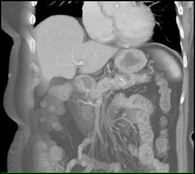 Intraductal Papillary Mucinous Neoplasm (IPMN) - CTisus CT Scan