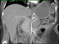 Pancreatic Cancer - CTisus CT Scan