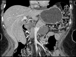 Cystadenoma - CTisus CT Scan