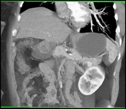 Islet Cell Tumor - CTisus CT Scan